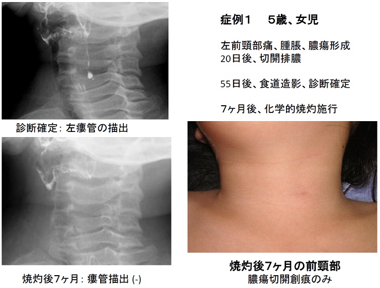 女児　症例 小児外科｜診療科一覧｜患者様へ｜四国中央病院